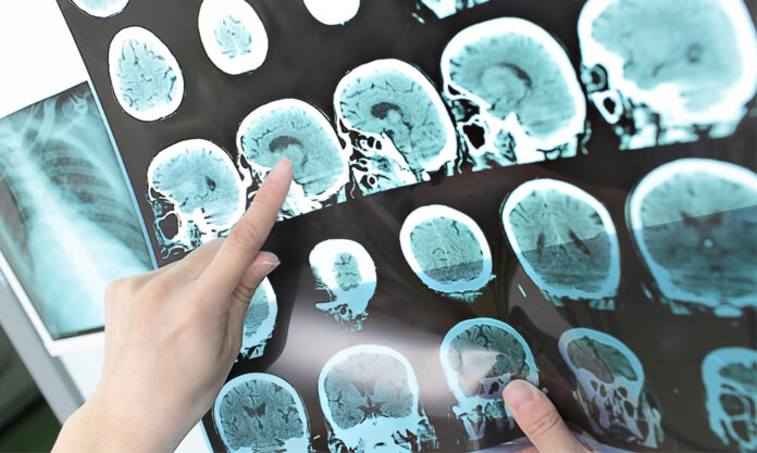 Detectan mediante resonancia magnética el daño axonal como biomarcador temprano en pacientes con esclerosis múltiple
